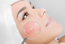 Broken Capillaries Treatment