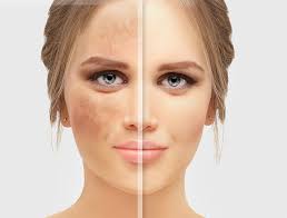 Age Spot Treatment