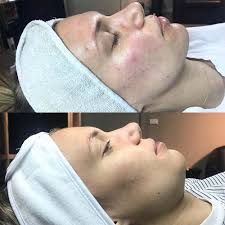 Salicylic Acid Peel