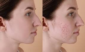 Acne Improvement Results