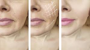 Overall Rejuvenation Results