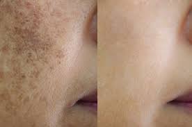 Sun Damage Reduction Results