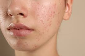 Anti-Blemish Facial