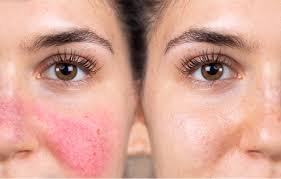 Rosacea Facial