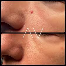 Cherry Angioma Treatment